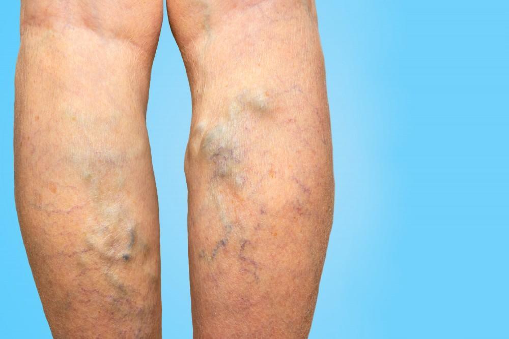 Why You Should Consider Venaseal Treatment for Varicose Veins