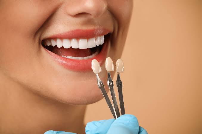 Dental Veneers in Turkey: A Data-Informed Guide to Modern Smile Treatment